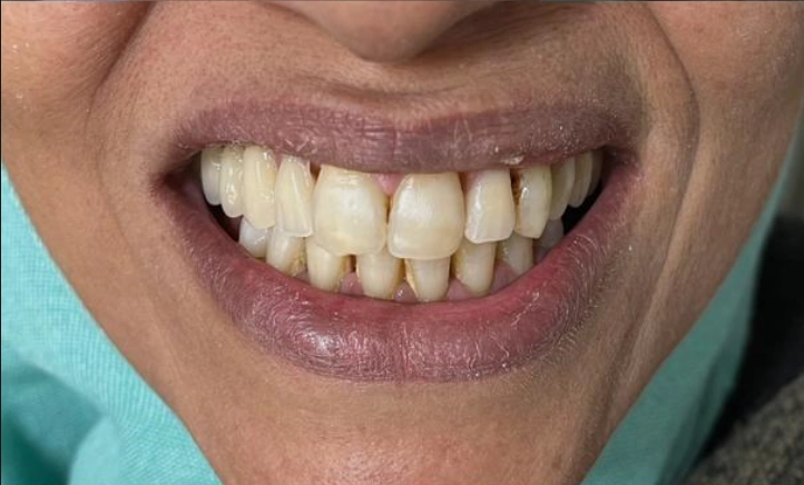 Avant traitement soins dentaires BioDental Annaba